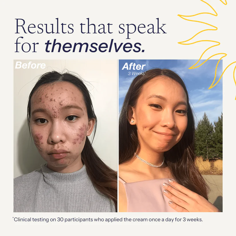 (🔥Buy 3 get 2 free🔥)-Acne cream absorbs easily, non-greasy, gentle, and non-irritating to skin.