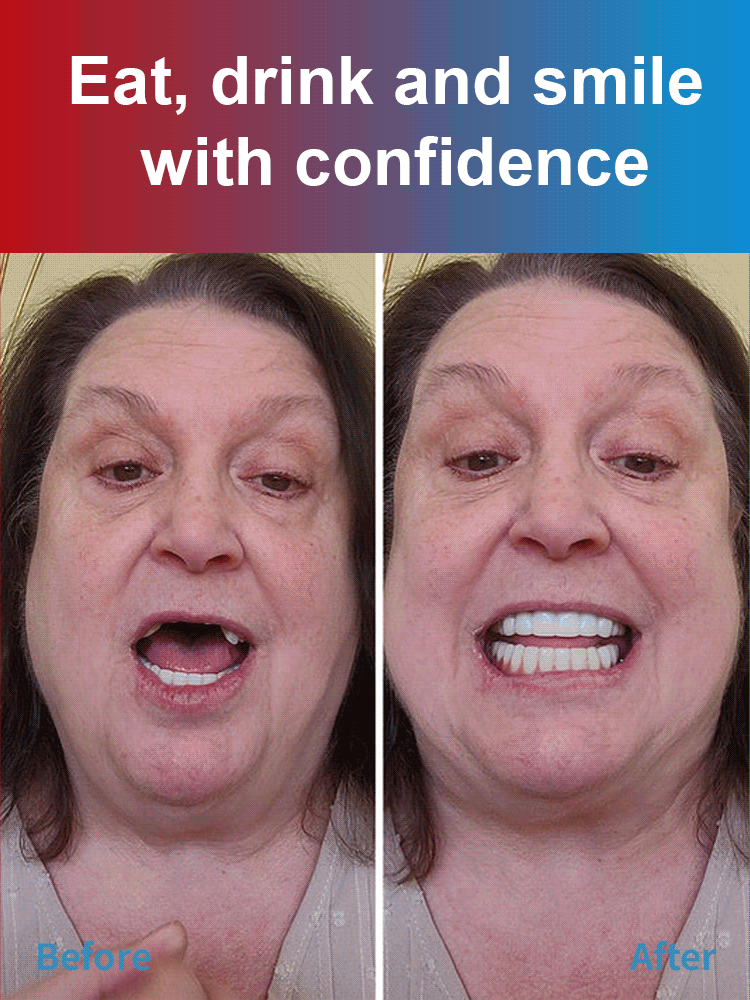 【EASY DENTURE™】The latest research and development from a top dental university, the third generation of silicone braces😁