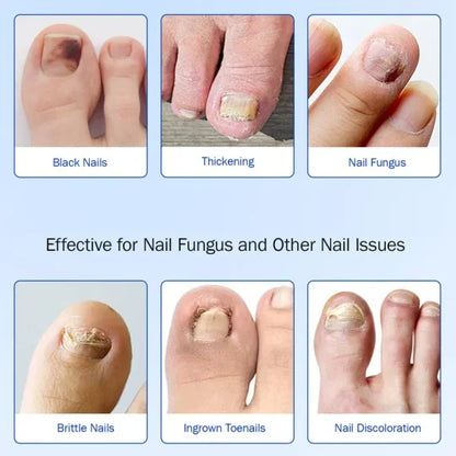 Nail care patches, onychomycosis care patches/21 pieces/box