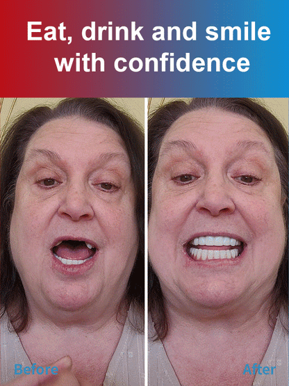 【EASY DENTURE™】The latest research and development from a top dental university, the third generation of silicone braces😁
